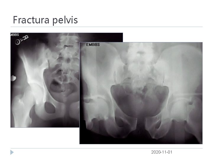 Fractura pelvis 2020 -11 -01 