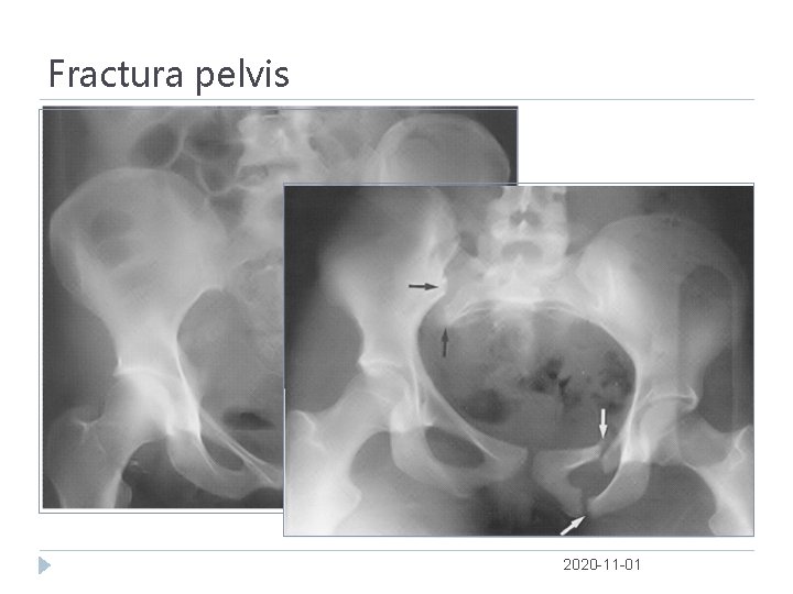 Fractura pelvis 2020 -11 -01 