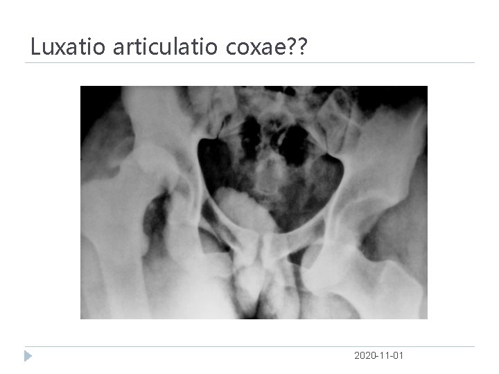 Luxatio articulatio coxae? ? 2020 -11 -01 