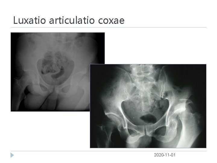 Luxatio articulatio coxae 2020 -11 -01 