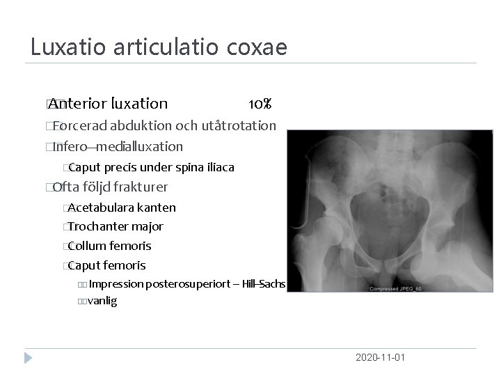 Luxatio articulatio coxae � Anterior � luxation 10% �Forcerad � abduktion och utåtrotation �Infero‐‐‐medial