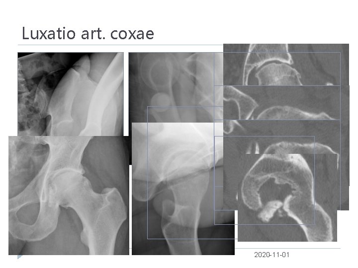 Luxatio art. coxae 2020 -11 -01 