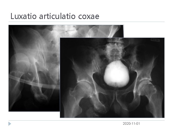 Luxatio articulatio coxae 2020 -11 -01 