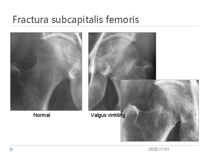 Fractura subcapitalis femoris Normal Valgus vinkling 2020 -11 -01 
