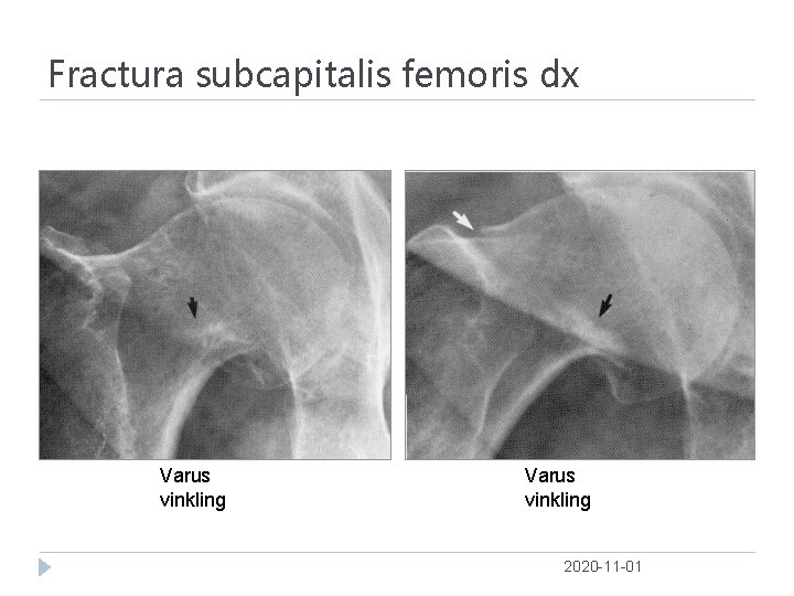 Fractura subcapitalis femoris dx Varus vinkling 2020 -11 -01 