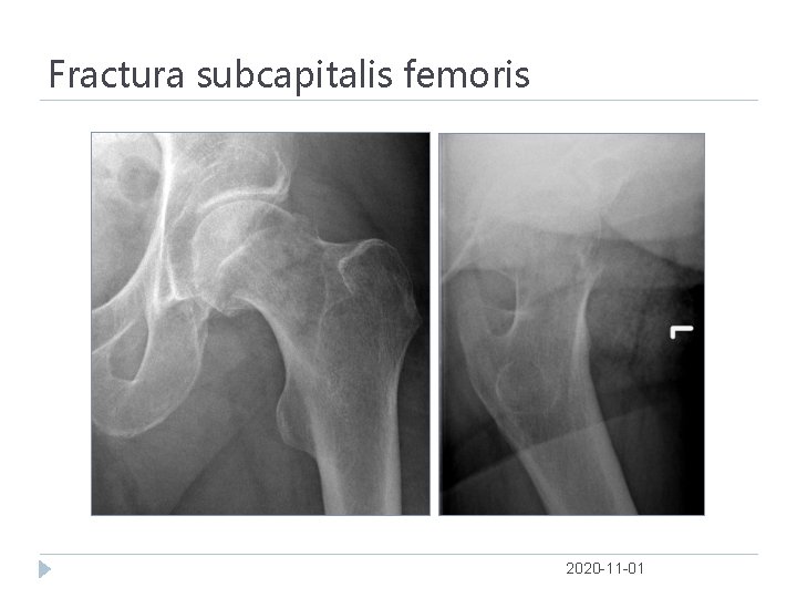 Fractura subcapitalis femoris 2020 -11 -01 