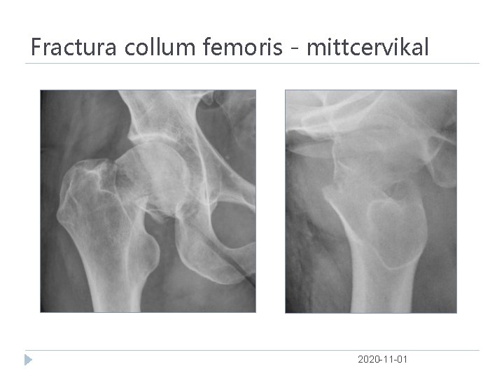 Fractura collum femoris - mittcervikal 2020 -11 -01 
