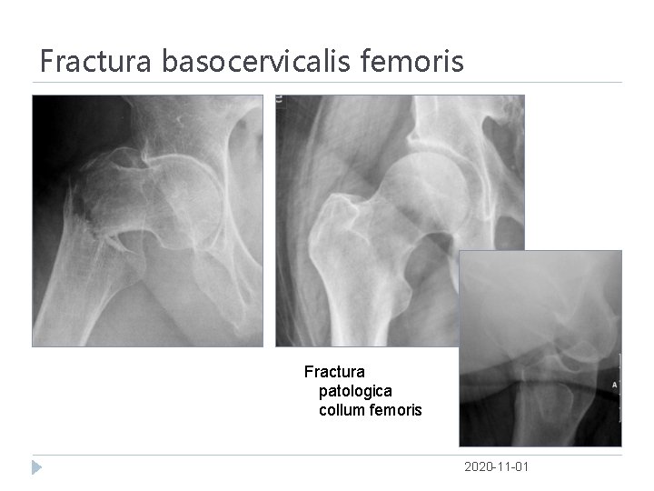 Fractura basocervicalis femoris Fractura patologica collum femoris 2020 -11 -01 