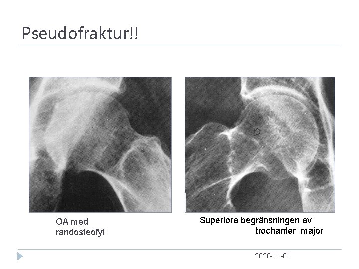 Pseudofraktur!! OA med randosteofyt Superiora begränsningen av trochanter major 2020 -11 -01 