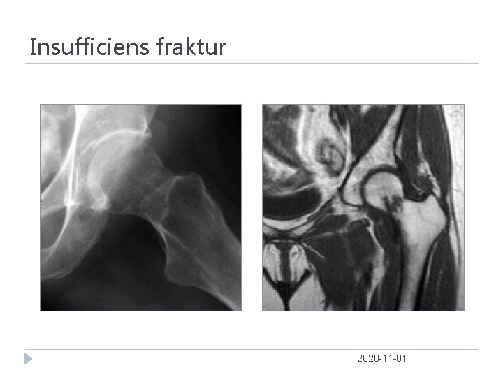 Insufficiens fraktur 2020 -11 -01 