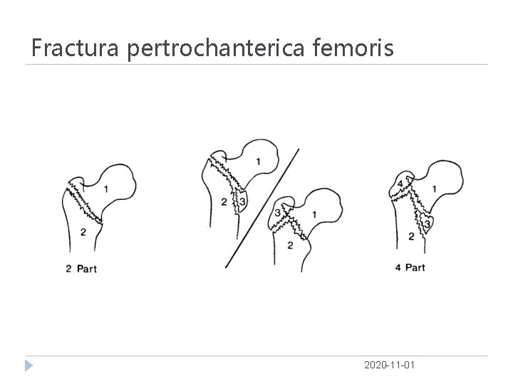 Fractura pertrochanterica femoris 2020 -11 -01 