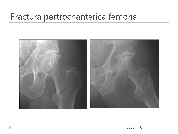 Fractura pertrochanterica femoris 2020 -11 -01 