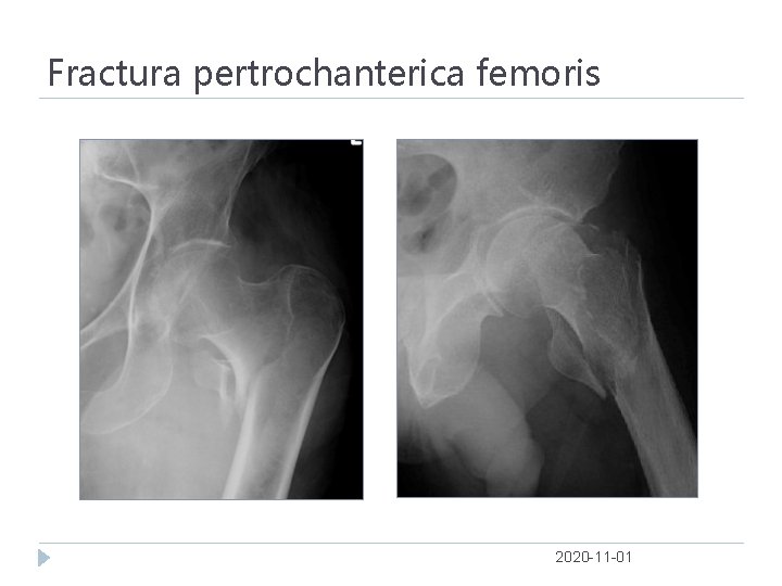 Fractura pertrochanterica femoris 2020 -11 -01 