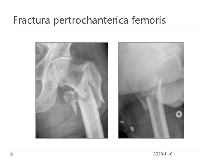 Fractura pertrochanterica femoris 2020 -11 -01 