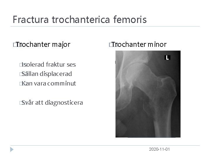 Fractura trochanterica femoris � Trochanter � major � Trochanter � minor �Oftest � �Isolerad