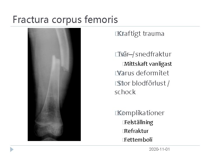 Fractura corpus femoris � Kraftigt � trauma � Tvär‐‐‐ � / snedfraktur � Mittskaft