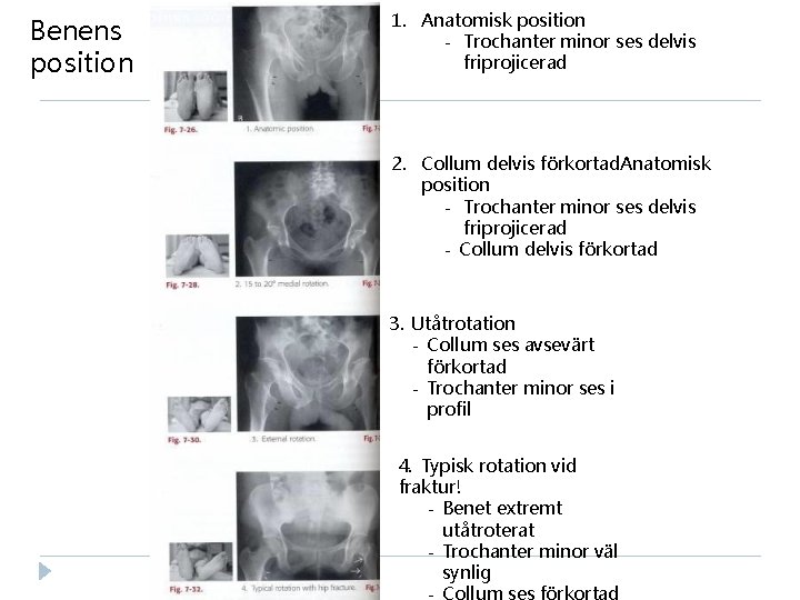 Benens position 1. Anatomisk position - Trochanter minor ses delvis friprojicerad 2. Collum delvis