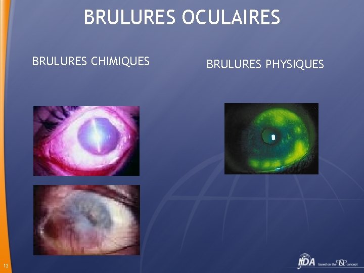 BRULURES OCULAIRES BRULURES CHIMIQUES 12 BRULURES PHYSIQUES 