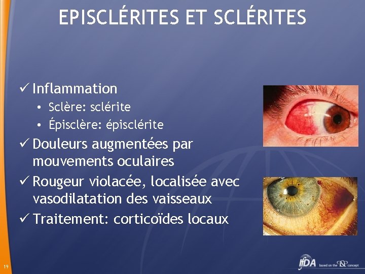 EPISCLÉRITES ET SCLÉRITES ü Inflammation • Sclère: sclérite • Épisclère: épisclérite ü Douleurs augmentées