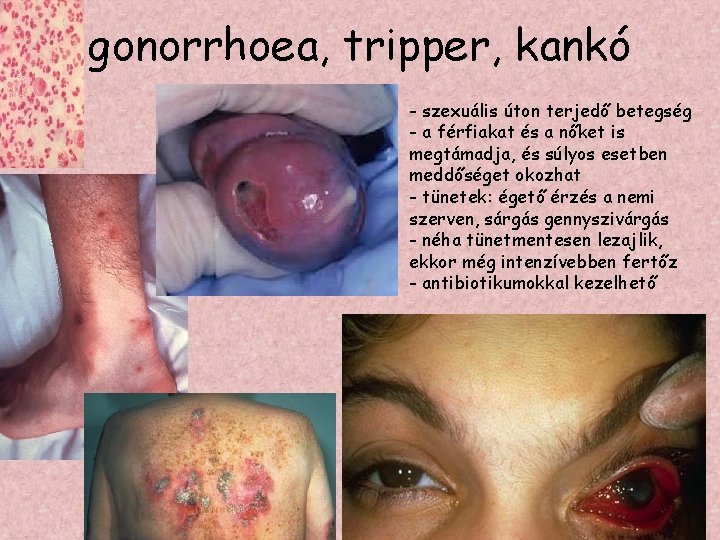 gonorrhoea, tripper, kankó - szexuális úton terjedő betegség - a férfiakat és a nőket