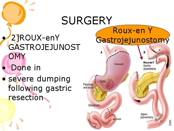 SURGERY • 2]ROUX-en. Y GASTROJEJUNOST OMY • Done in • severe dumping following gastric