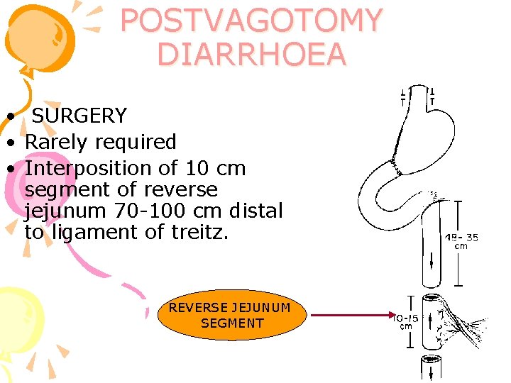 POSTVAGOTOMY DIARRHOEA • SURGERY • Rarely required • Interposition of 10 cm segment of