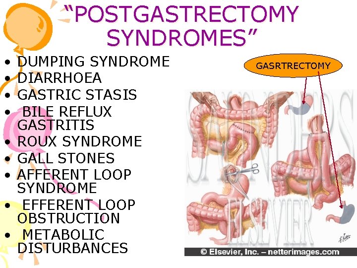 “POSTGASTRECTOMY SYNDROMES” • • • DUMPING SYNDROME DIARRHOEA GASTRIC STASIS BILE REFLUX GASTRITIS ROUX