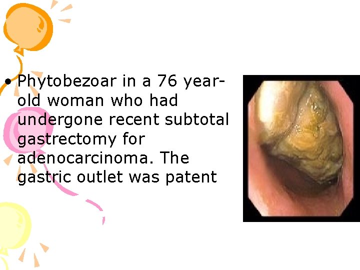  • Phytobezoar in a 76 yearold woman who had undergone recent subtotal gastrectomy