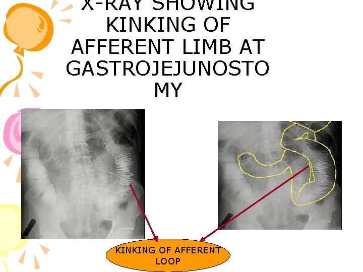 X-RAY SHOWING KINKING OF AFFERENT LIMB AT GASTROJEJUNOSTO MY KINKING OF AFFERENT LOOP 