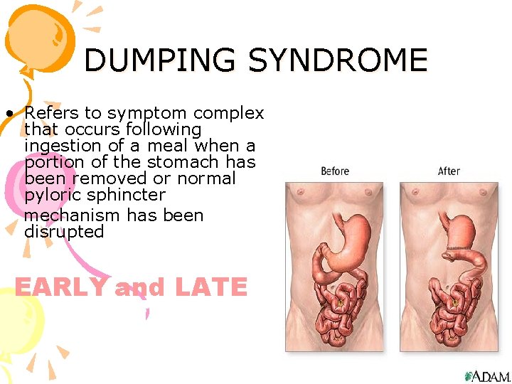 DUMPING SYNDROME • Refers to symptom complex that occurs following ingestion of a meal