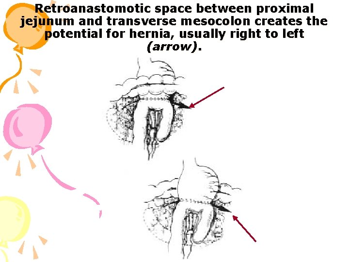 Retroanastomotic space between proximal jejunum and transverse mesocolon creates the potential for hernia, usually