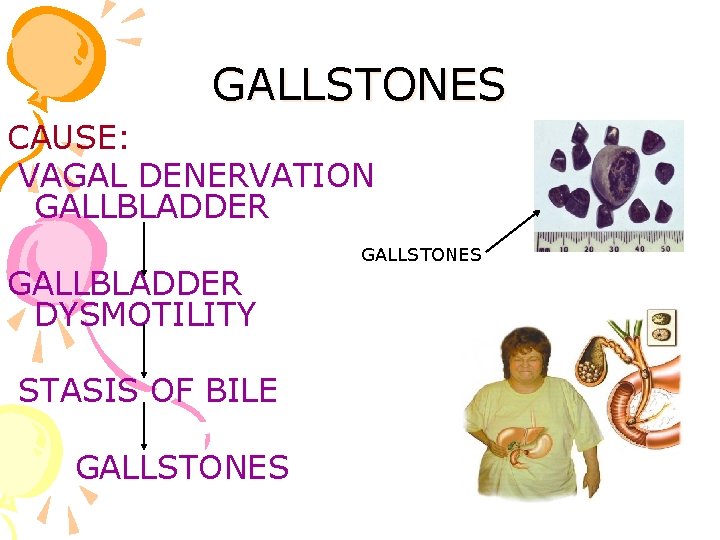 GALLSTONES CAUSE: VAGAL DENERVATION GALLBLADDER DYSMOTILITY STASIS OF BILE GALLSTONES 