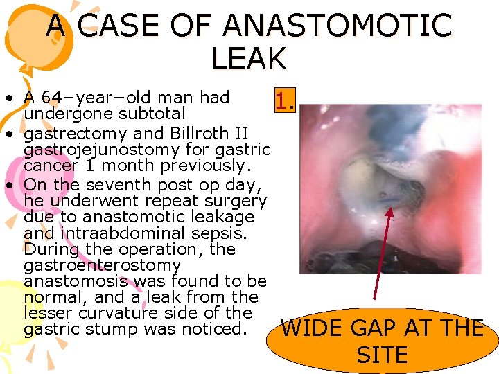 A CASE OF ANASTOMOTIC LEAK • A 64−year−old man had 1. undergone subtotal •