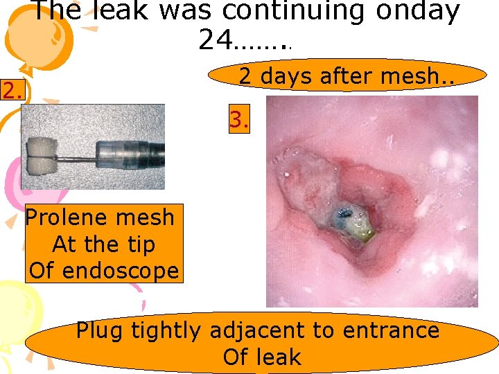 The leak was continuing onday 24……. . 2 days after mesh. . 2. 3.