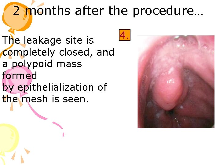 2 months after the procedure… The leakage site is completely closed, and a polypoid