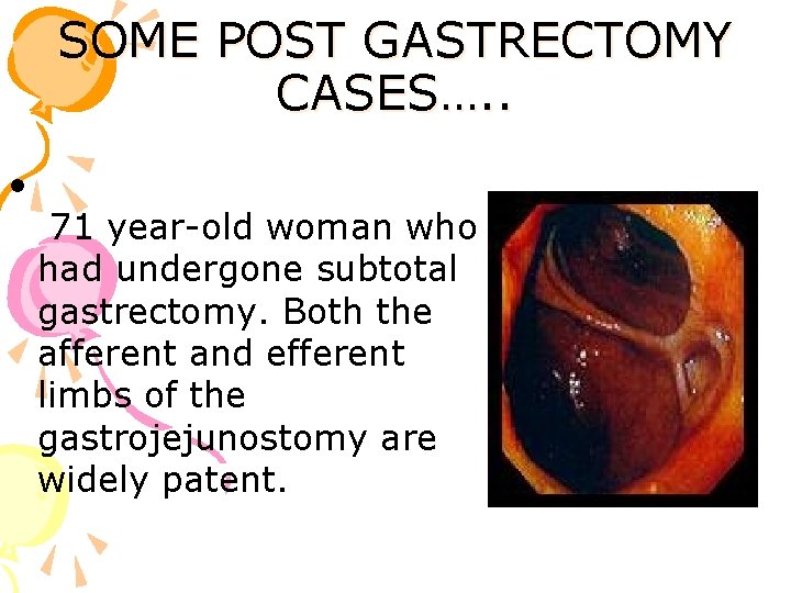 SOME POST GASTRECTOMY CASES…. . • 71 year-old woman who had undergone subtotal gastrectomy.