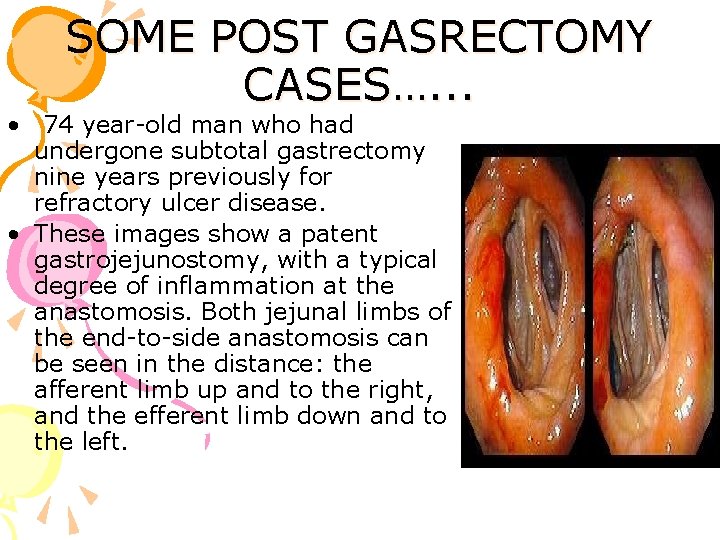 SOME POST GASRECTOMY CASES…. . . • 74 year-old man who had undergone subtotal