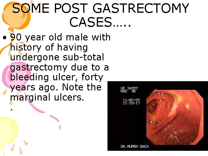 SOME POST GASTRECTOMY CASES…. . • 90 year old male with history of having