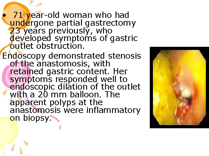  • 71 year-old woman who had undergone partial gastrectomy 23 years previously, who