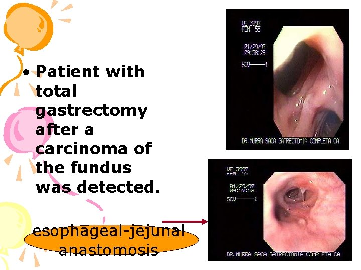  • Patient with total gastrectomy after a carcinoma of the fundus was detected.
