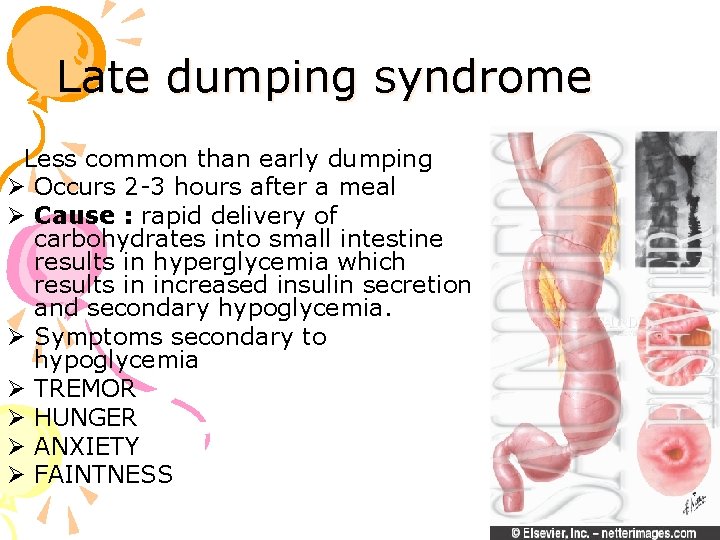 Late dumping syndrome Less common than early dumping Ø Occurs 2 -3 hours after
