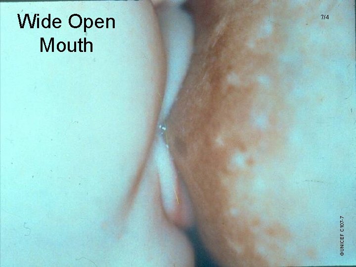 ©UNICEF C 107 -7 Wide Open Mouth 7/4 