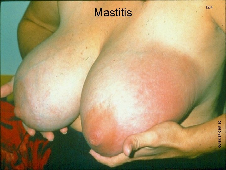 ©UNICEF C 107 -39 Mastitis 12/4 
