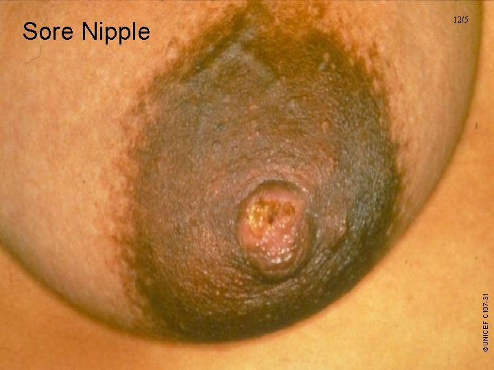 ©UNICEF C 107 -31 Sore Nipple 12/5 