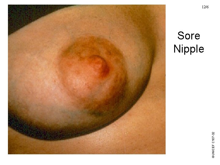 ©UNICEF C 107 -32 12/6 Sore Nipple 