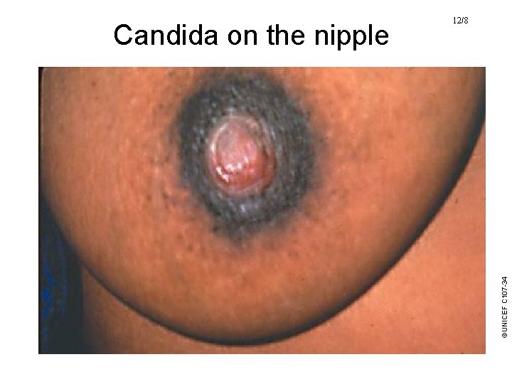 ©UNICEF C 107 -34 Candida on the nipple 12/8 