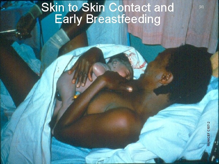 5/1 ©UNICEF C 107 -2 Skin to Skin Contact and Early Breastfeeding 