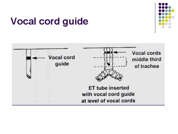 Vocal cord guide 