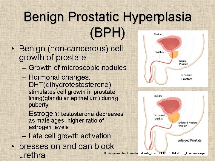 Benign Prostatic Hyperplasia (BPH) • Benign (non-cancerous) cell growth of prostate – Growth of