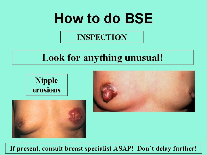 How to do BSE INSPECTION Look for anything unusual! Nipple erosions If present, consult